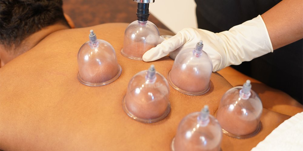 Cupping Therapy